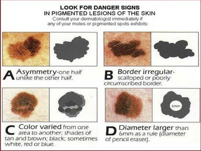 Skin Cancer Image